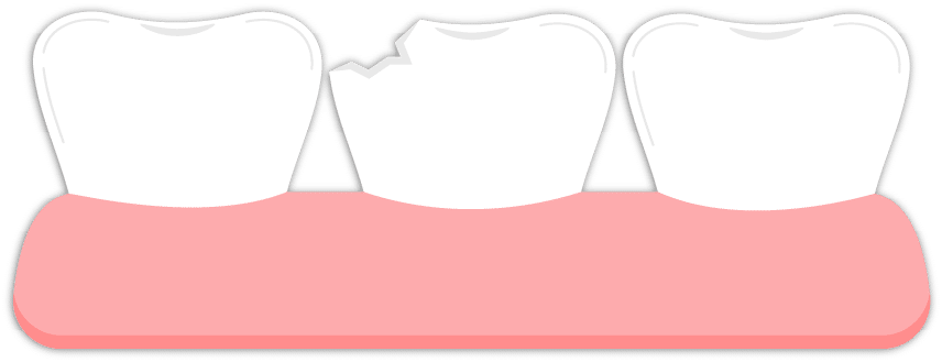 Chipped Tooth Repair